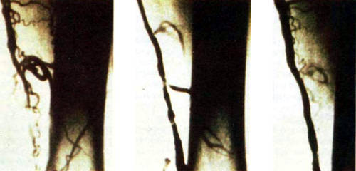 Рентгеновские снимки бедренных артерий демонстрируют достижения лазерной балонно-катетерной ангиопластики. На снимке слева артерия полностью заблокирована. После воздействия лазерного излучения от исходной закупорки осталось только 30% (в центре). Для расширения канала кровотока в артерию вводят катетер с надуваемым баллончиком, после чего нормальный кровоток восстанавливается (справа)